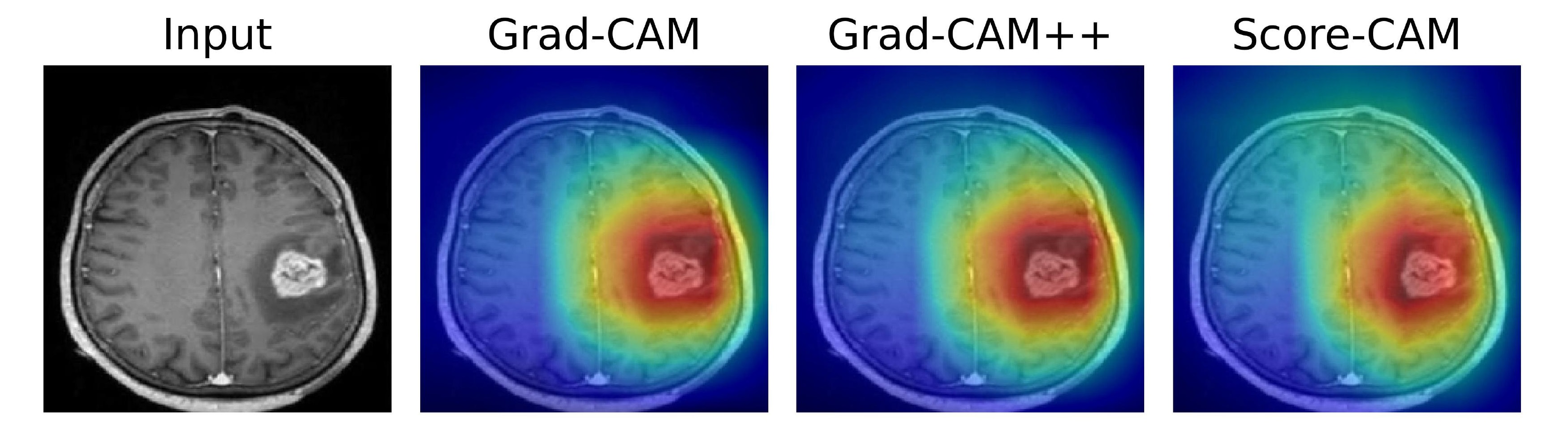 Glioma.jpg